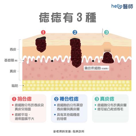 手臂長痣|為什麼臉上的痣越來越多？皮膚科醫師解析長痣原因、。